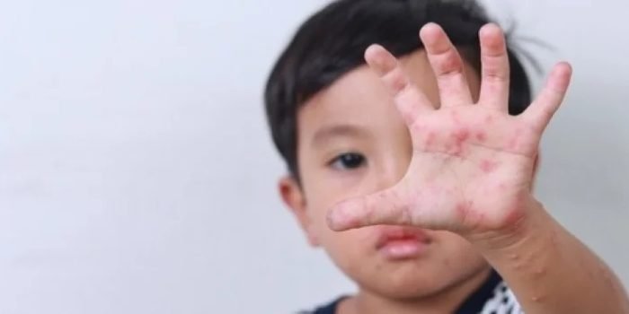 Waspada! 5 Ciri Flu Singapura pada Anak, Berikut Gejala dan Cara Penularannya