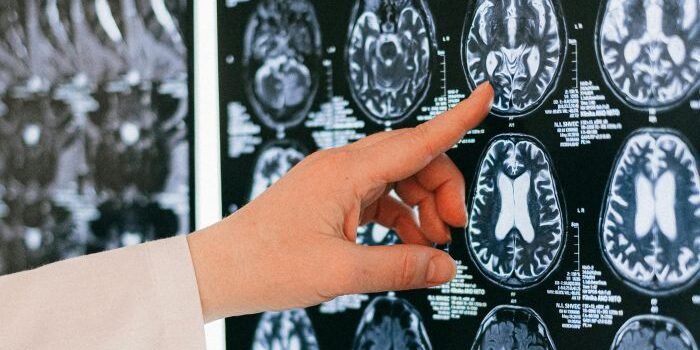 Anak Muda Waspada! Stroke Kini Tak Lagi Jadi Penyakit Orang Tua