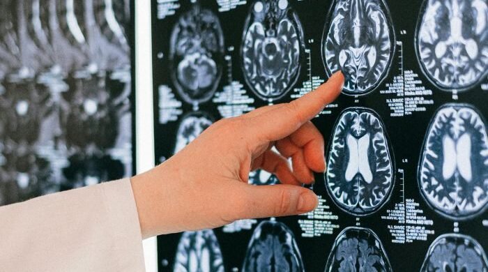 Ilustrasi stroke akibat pecahnya pembuluh darah di otak. Foto: pexels